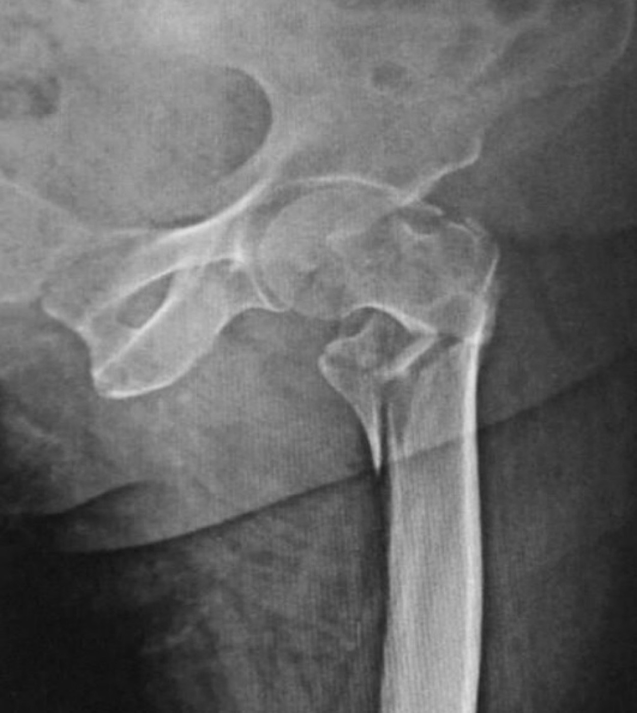 Figure 7. Comminuted (multifragmentary) trochanteric fracture of the proximal femur (high energy). Source: Memon, Patel & Juva, via Wikimedia Commons, CC BY 4.0.