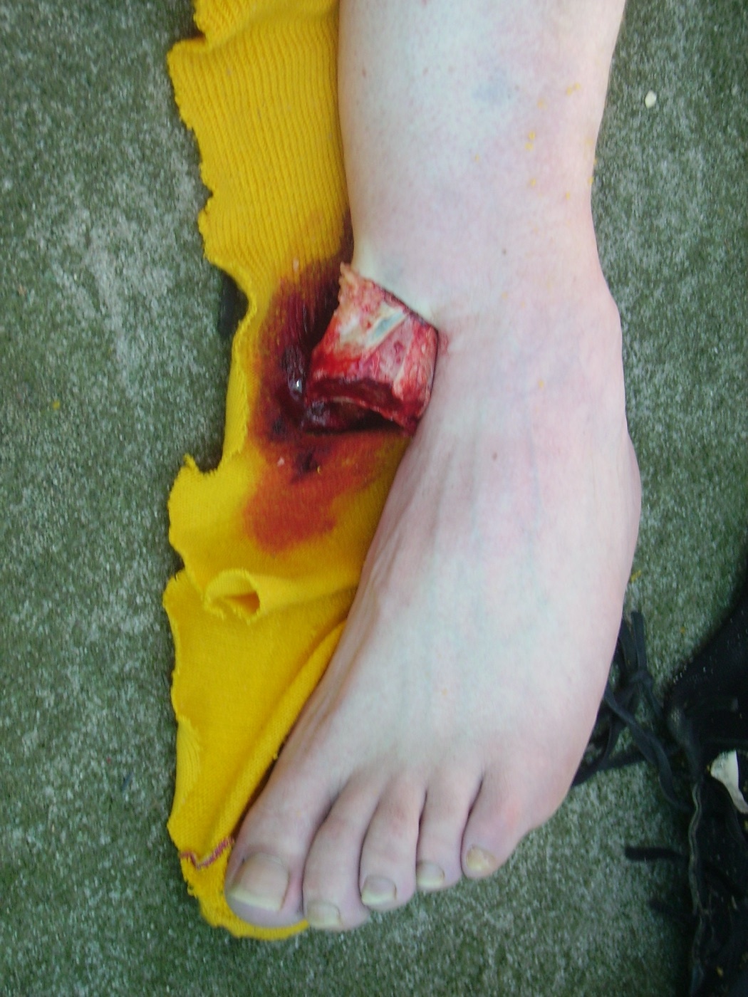 Figure 9. Open (compound) fracture-dislocation of the ankle: bone protruding through the disrupted soft-tissue envelope. Source: Xy01, via Wikimedia Commons, CC BY-SA 2.0 DE.