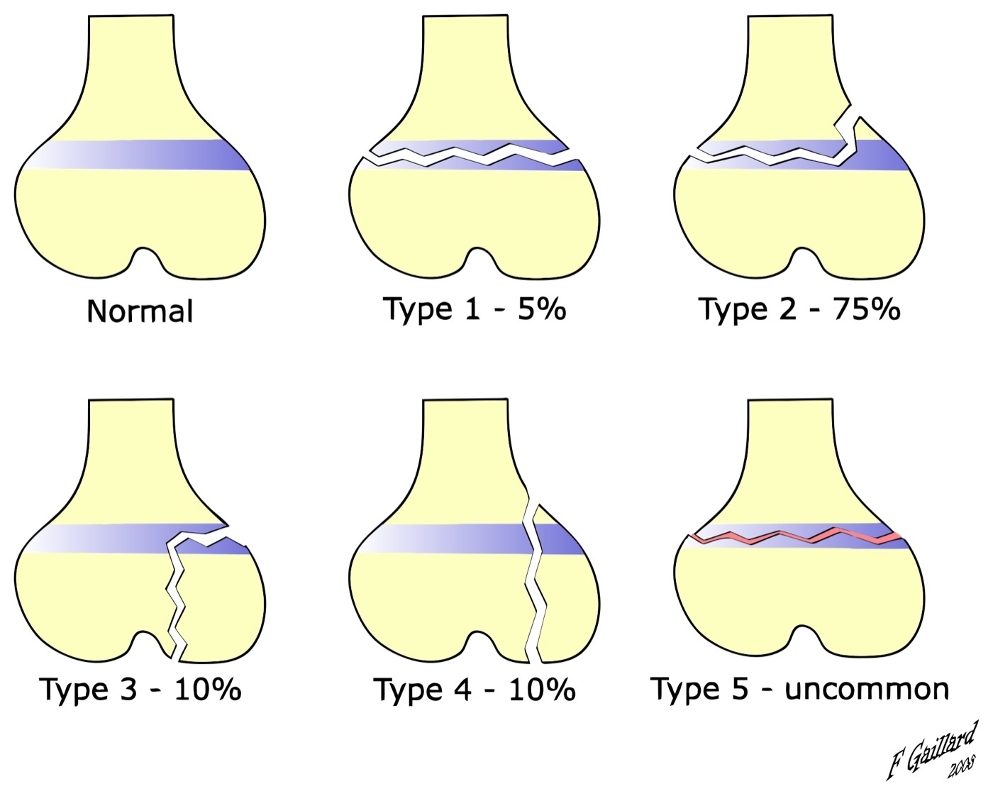 Figure 11. Salter-Harris classification of physeal injuries, types I-V. Source: Frank Gaillard (derivative by Zerodamage), via Wikimedia Commons, CC BY-SA 3.0.