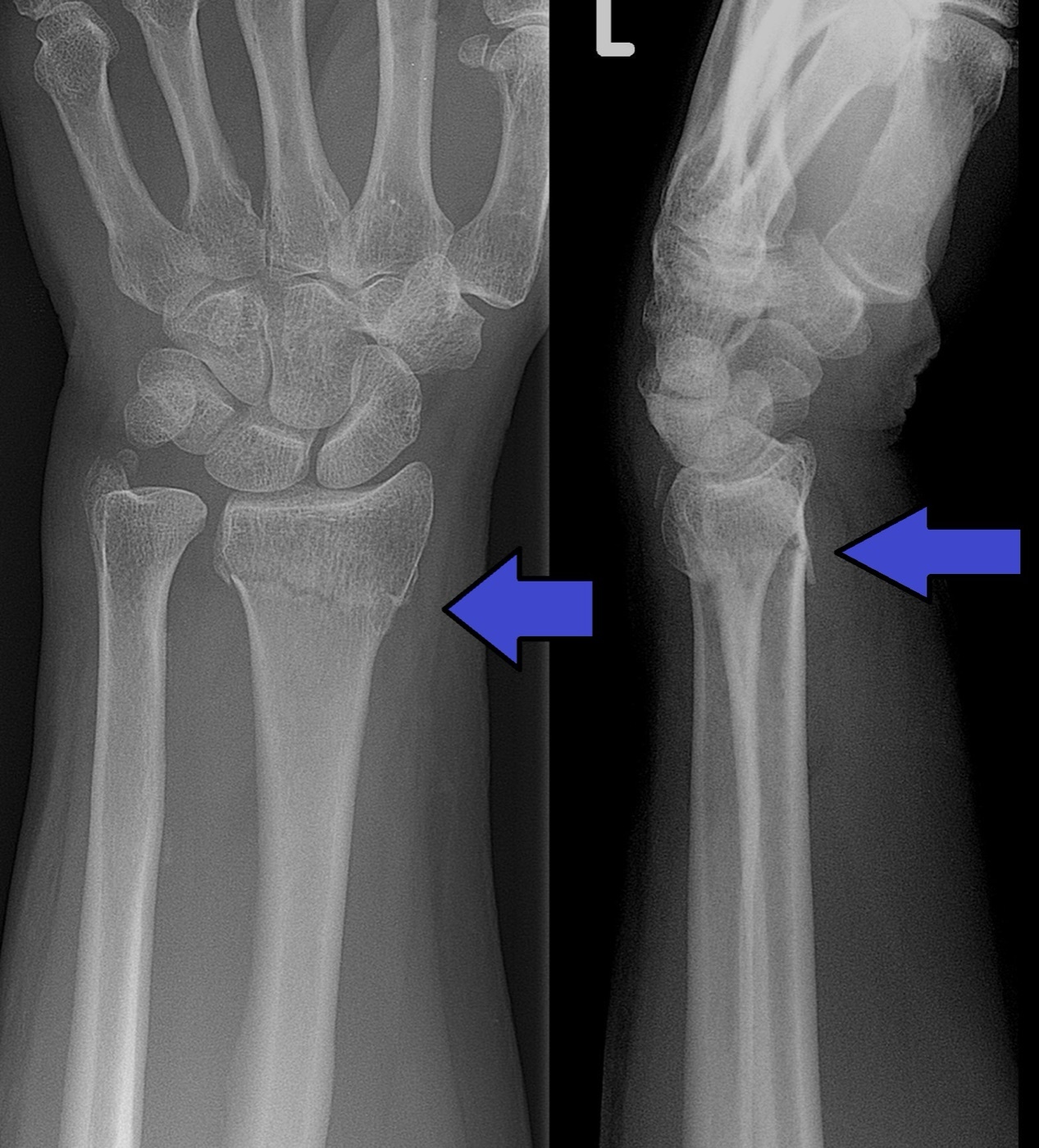 Figure 12. A Colles fracture - an extra-articular distal-radius metaphyseal fracture, the archetypal eponymous fracture. Source: Lucien Monfils, via Wikimedia Commons, CC BY-SA 3.0.