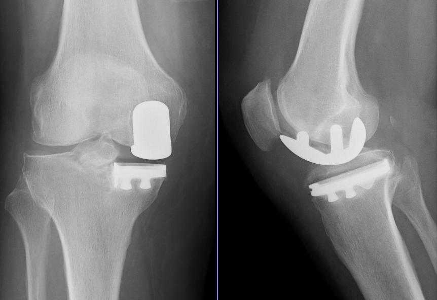 Medial unicompartmental knee arthroplasty. AP and lateral radiographs of a medial UKA (femoral runner and tibial baseplate, medial compartment only). MBq, public domain, via Wikimedia Commons.