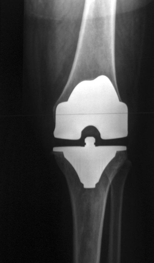 Total knee arthroplasty. Post-operative AP and lateral radiographs of a posterior-stabilised TKA (femoral and tibial components, polyethylene insert, patellar button on the lateral view). Frédéric Jacquot (fpjacquot), CC BY-SA 3.0, via Wikimedia Commons.
