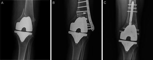 Periprosthetic supracondylar femoral fracture after TKA. A fracture above the femoral component, here treated by plate fixation - a characteristic late complication. Gondalia et al., J Orthop Traumatol 2014;15(3):201-207, Fig. 1, CC BY.