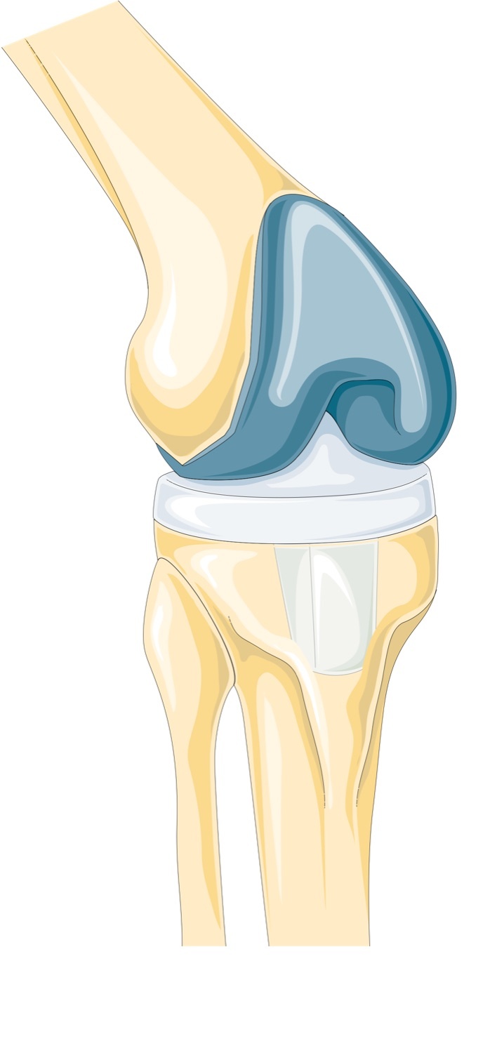 Knee joint anatomy (parasagittal section). The femoral, tibial and patellar articular surfaces (cartilage in blue) whose progressive loss defines gonarthrosis. Servier Medical Art (Laboratoires Servier), CC BY-SA 3.0, via Wikimedia Commons.