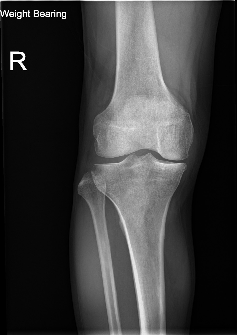 Medial-compartment gonarthrosis. Weight-bearing AP radiograph of the knee showing medial joint-space narrowing - the commonest pattern, associated with varus. Ptrump16, CC BY-SA 4.0, via Wikimedia Commons.