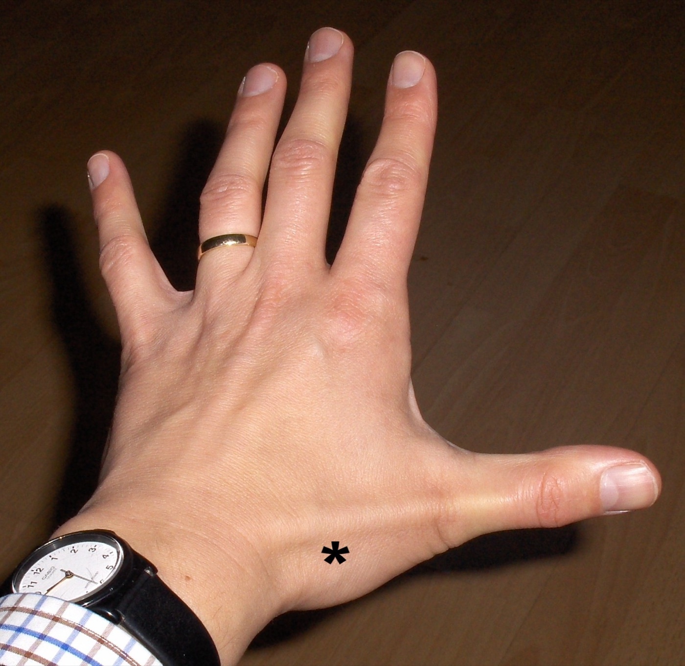 Figure 13. The anatomical snuffbox, whose floor is the scaphoid crossed by the radial artery, bounded by the extensor pollicis longus and the abductor pollicis longus / extensor pollicis brevis tendons. James Heilman MD, CC BY-SA 4.0, via Wikimedia Commons.