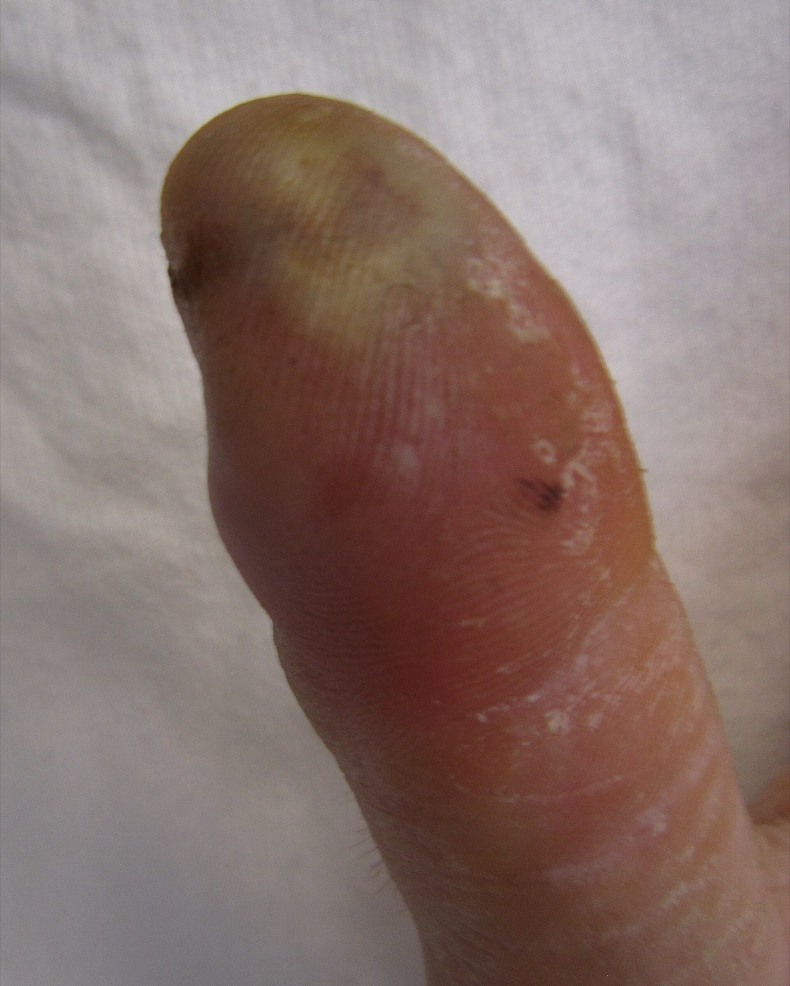 Figure 15. A felon: a closed, septate pulp-space infection of the thumb. James Heilman MD, CC BY-SA 3.0, via Wikimedia Commons.