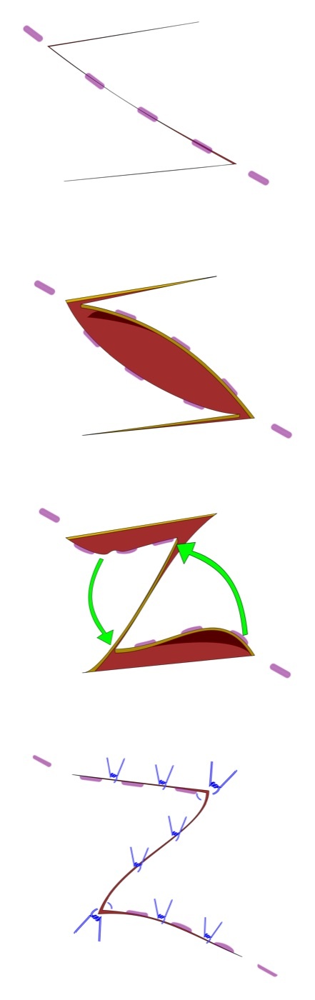 Figure 18. The Z-plasty in four stages: the Z incision design, the two triangular flaps raised, their transposition (arrows), and the closed result with the central limb re-oriented and lengthened. Evan Mason, CC BY-SA 4.0, via Wikimedia Commons.