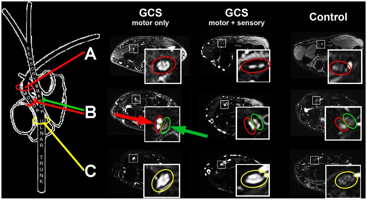 Figure 6. Magnetic resonance neurography of the ulnar nerve and its branches in the canal of Guyon. Kollmer et al., CC BY 4.0, via Wikimedia Commons.