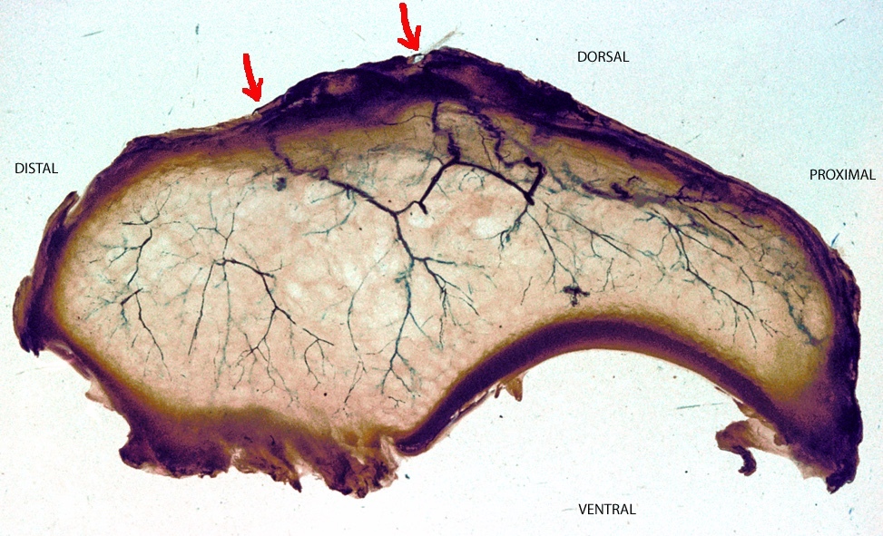 Figure 12. The retrograde blood supply of the scaphoid, entering distally so that the proximal pole is perfused last and is prone to avascular necrosis. Nelsonmleite, CC BY-SA 3.0, via Wikimedia Commons.