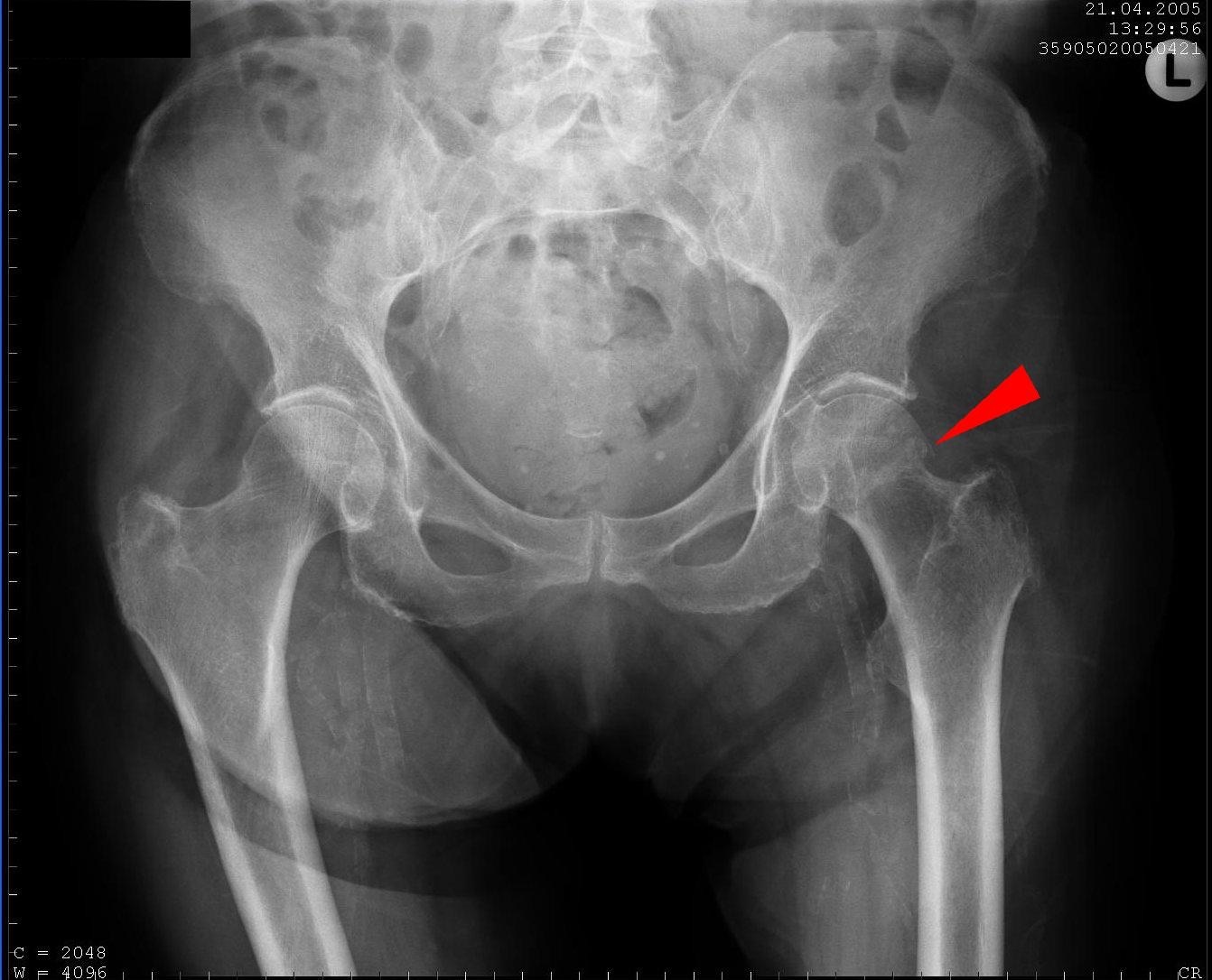 Figure 13. Non-displaced subcapital femoral neck fracture (arrow) on an AP pelvic radiograph, the injury that tears the retinacular vessels and risks avascular necrosis. Hellerhoff, CC BY-SA 3.0, via Wikimedia Commons.