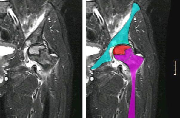 Figure 15. Avascular necrosis of the femoral head on coronal MRI (necrotic segment highlighted). Jmarchn, CC BY-SA 3.0, via Wikimedia Commons.
