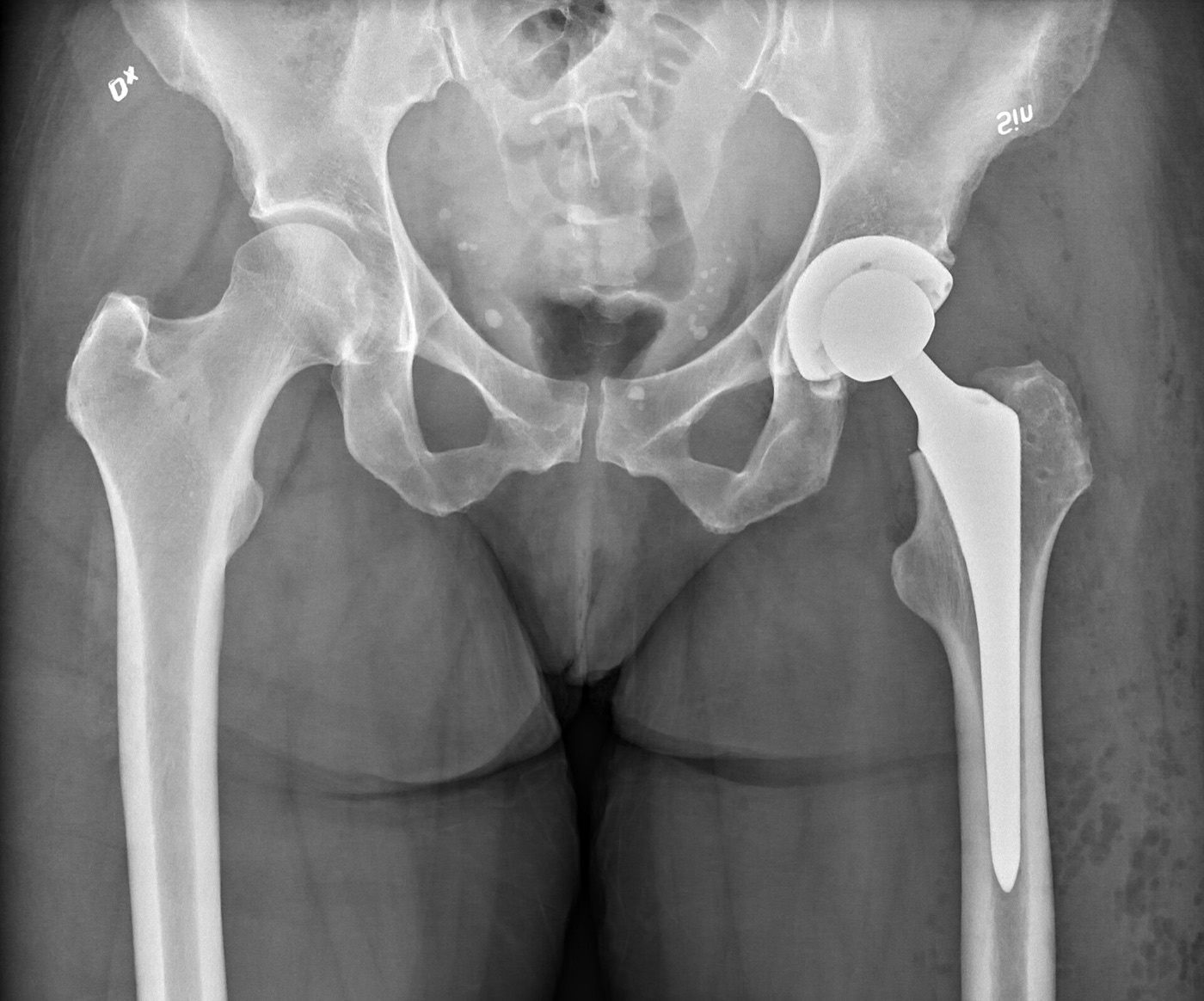 Figure 16. Total hip replacement: AP pelvic radiograph of a left total hip arthroplasty. Mikael Häggström, CC0, via Wikimedia Commons.