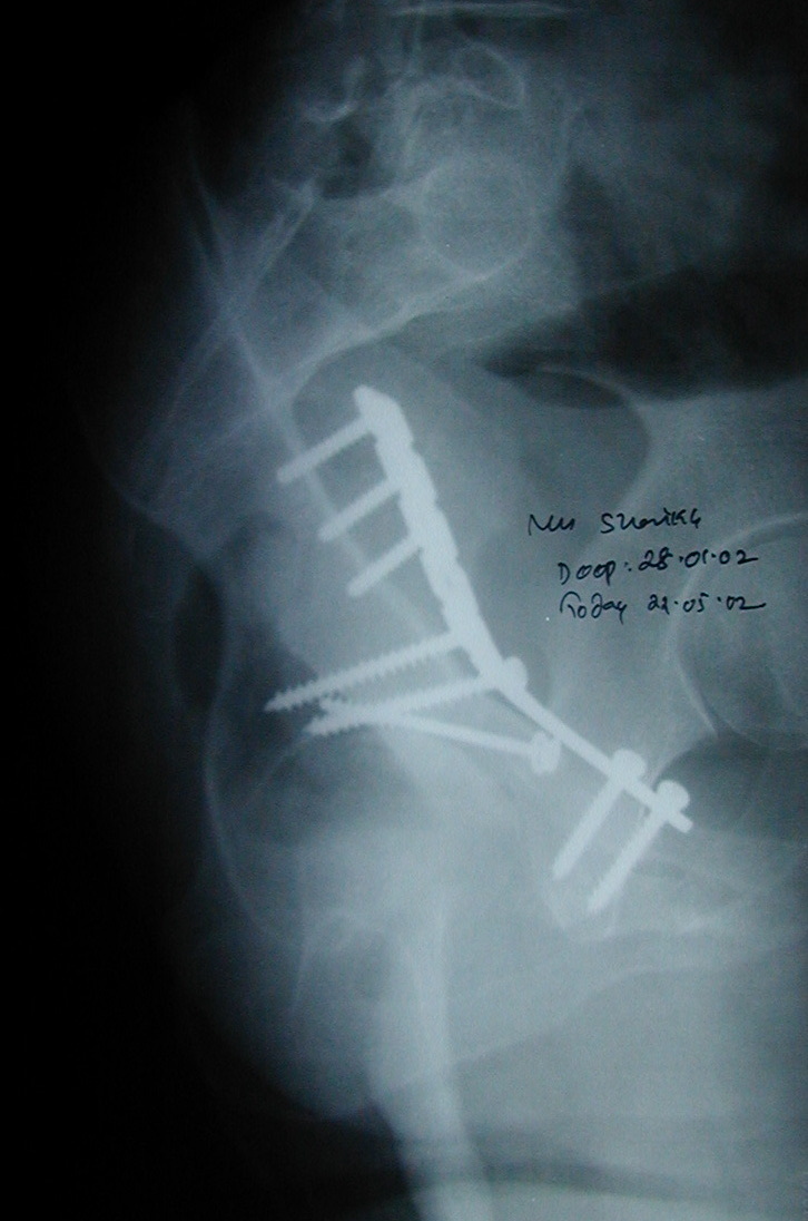 Figure 12. An acetabular fracture after open reduction and internal fixation with a reconstruction plate and screws (postoperative radiograph). Dr. C. J. Thakkar, CC BY-SA 4.0, via Wikimedia Commons.