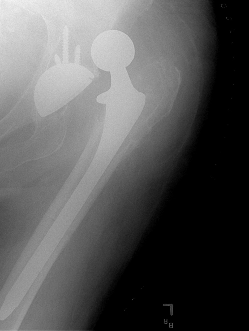 Figure 14. A dislocated total hip arthroplasty, an alternative to fixation in the elderly acetabular fracture. Bill Rhodes, CC BY 2.0, via Wikimedia Commons.