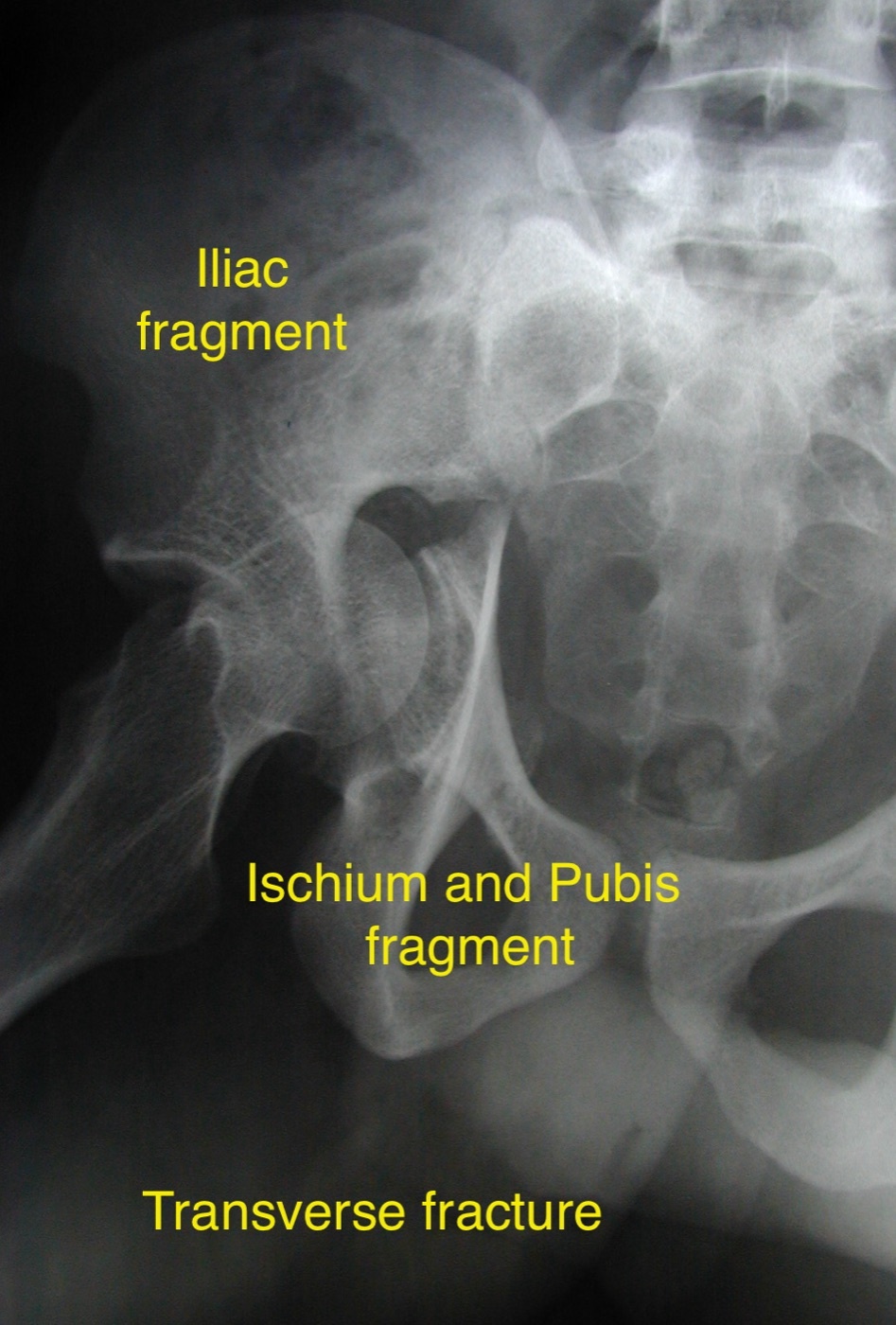 Figure 6. A transverse acetabular fracture on an oblique (Judet) radiograph, separating the iliac from the ischiopubic fragment. Dr. C. J. Thakkar, CC BY-SA 4.0, via Wikimedia Commons.