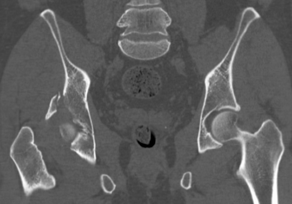 Figure 7. An acetabular fracture on axial CT. James Heilman, MD, CC BY-SA 4.0, via Wikimedia Commons.