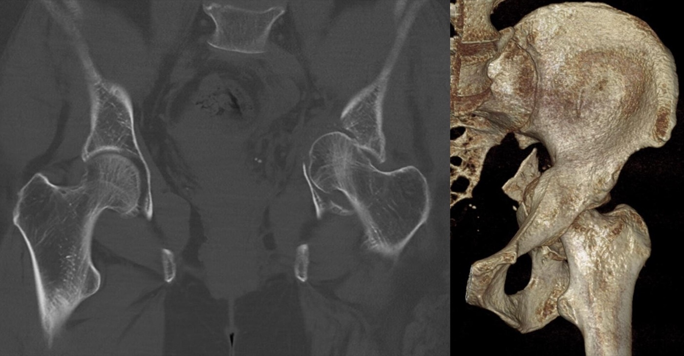 Figure 8. A central acetabular fracture-dislocation on CT (coronal reformat and 3D reconstruction): the femoral head is driven medially through the acetabulum. Hellerhoff, CC BY-SA 3.0, via Wikimedia Commons.