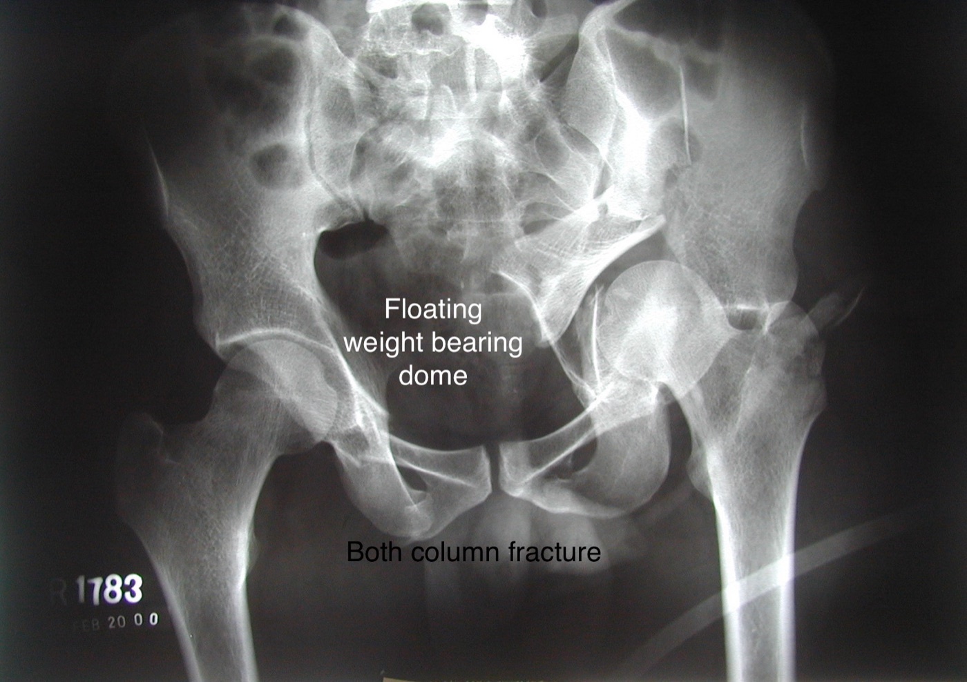 Figure 9. A both-column acetabular fracture with dissociation of the weight-bearing dome on AP radiograph. Dr. C. J. Thakkar, CC BY-SA 4.0, via Wikimedia Commons.