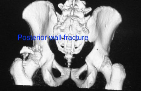 Figure 10. A posterior wall acetabular fracture on 3D CT reconstruction. Dr. C. J. Thakkar, CC BY-SA 4.0, via Wikimedia Commons.