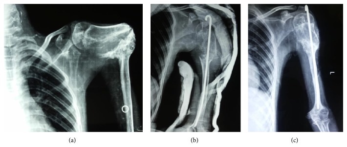 Figure 13. Hypertrophic nonunion of the humeral shaft (left), treated to union by fixation (right). From Magu et al. (2014), Case Rep Orthop 2014:854349, PMC4266758, CC BY.
