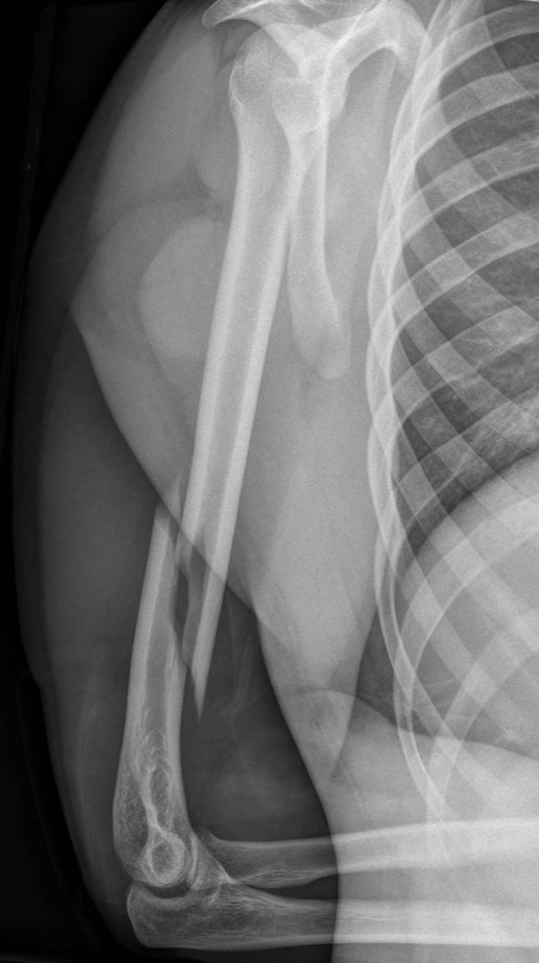 Figure 2. Spiral fracture of the humeral shaft sustained while arm-wrestling, the classic torsional mechanism. Source: Hellerhoff, via Wikimedia Commons, CC BY-SA 4.0.
