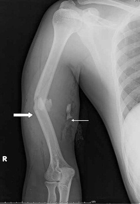 Figure 3. Displaced comminuted (multifragmentary) mid-shaft humeral fracture, an AO type-C pattern. From Pathak et al. (2012), J Med Case Rep 6:192, PMC3419694, CC BY 2.0.