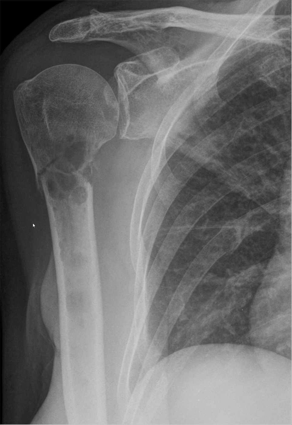 Figure 9. Pathological humeral fracture through osteolytic metastatic breast carcinoma, an operative indication. Source: Hellerhoff, via Wikimedia Commons, CC BY-SA 4.0.