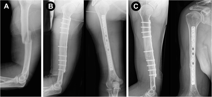 Figure 10. Humeral shaft fracture treated by open reduction and compression-plate fixation (a long limited-contact dynamic compression plate), pre- and post-operative views. From BMC Musculoskeletal Disorders 2019;20:527, PMC6844056, CC BY 4.0.