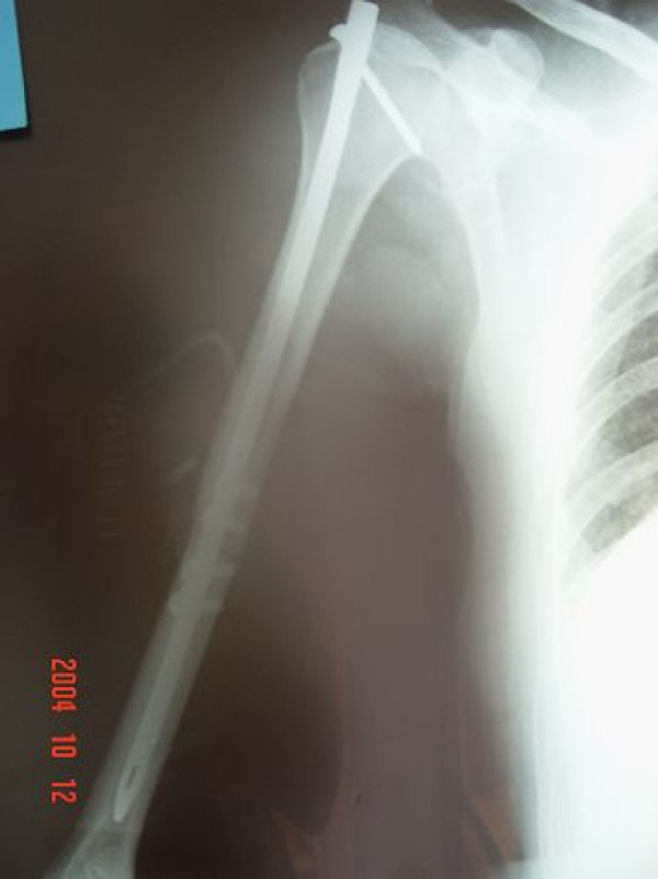 Figure 11. Humeral shaft fracture treated by antegrade intramedullary nailing. From Kazakos et al. (2009), Cases J 2:9075, PMC2803872, CC BY 2.0.