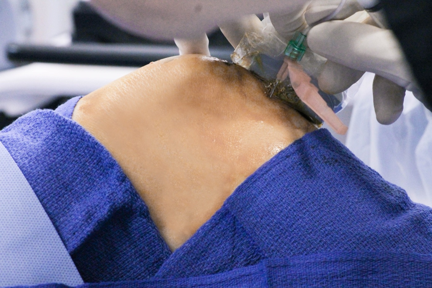 Figure 14. Knee arthrocentesis: aspiration of joint fluid is the key investigation in suspected septic arthritis. Source: PainDoctorUSA, via Wikimedia Commons, CC BY-SA 4.0.