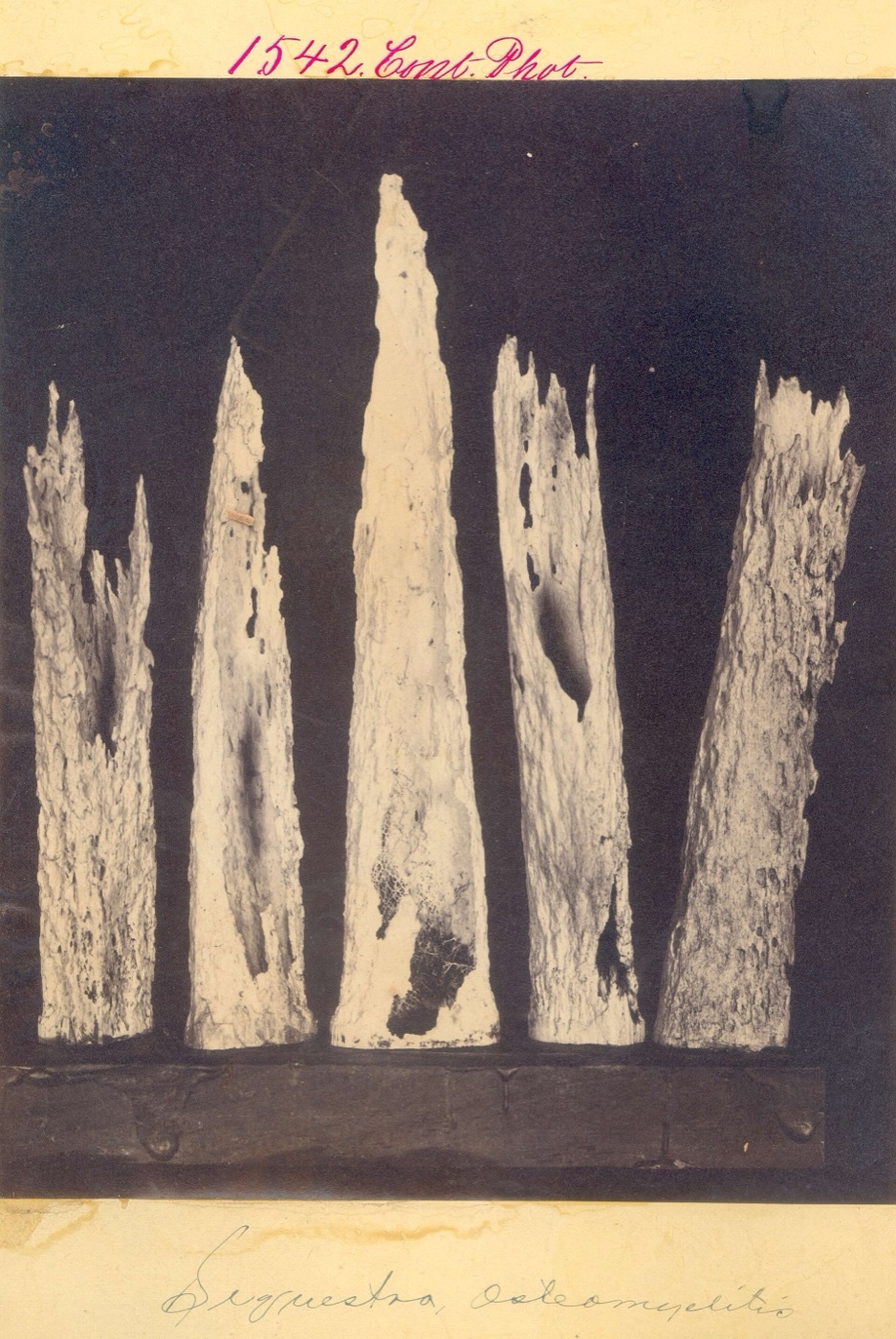 Figure 2. Gross-pathology specimen of bony sequestra: fragments of dead, detached cortical bone that behave as biofilm-colonised foreign bodies. Source: Otis Historical Archives, National Museum of Health & Medicine, via Wikimedia Commons, CC BY 2.0.