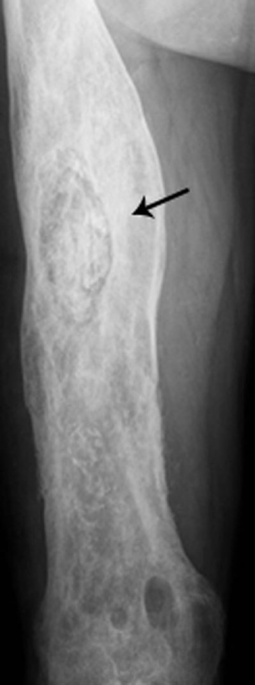 Figure 3. Femoral radiograph in chronic osteomyelitis: a dense detached sequestrum within a thickened, sclerotic cortex (involucrum), with distal lytic destruction. From Desimpel, Posadzy & Vanhoenacker (2017), PMC6032807, CC BY 4.0.