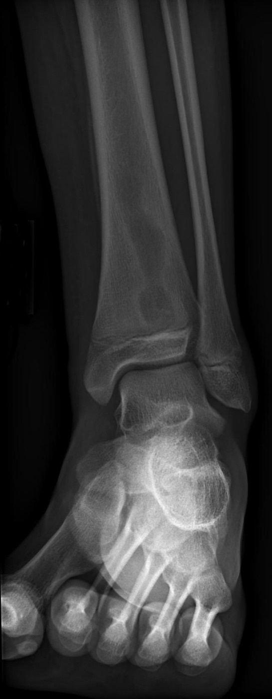 Figure 4. Radiograph of a Brodie abscess: a well-defined metaphyseal lucency in the distal tibia, the plain-film correlate of subacute osteomyelitis. Source: Jto410, via Wikimedia Commons, CC BY-SA 3.0.