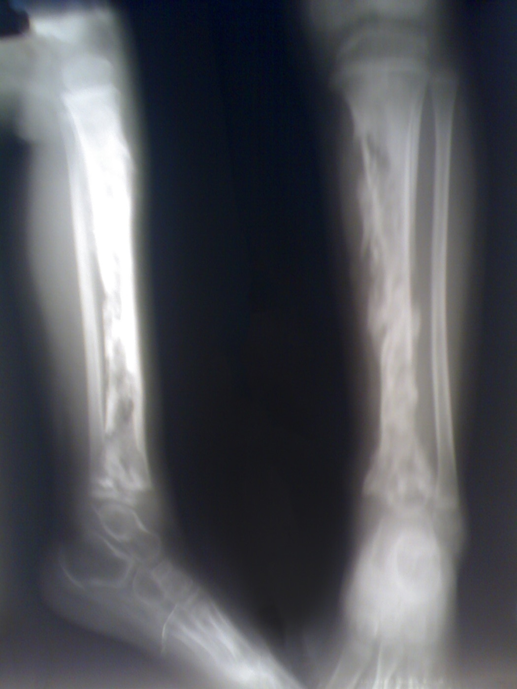 Figure 5. Acute haematogenous osteomyelitis of the tibia in a child: multiple radiolucent abscesses and metaphyseal bony destruction, reflecting metaphyseal seeding. Source: sarindam7, via Wikimedia Commons, CC BY-SA 4.0.