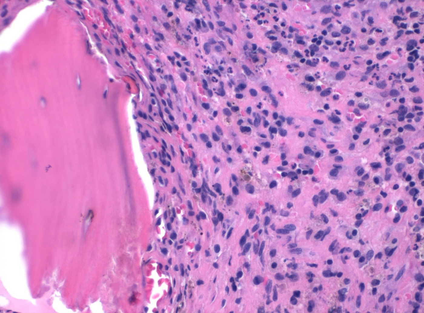 Figure 6. Histopathology of acute osteomyelitis (H\&E): a bony trabecula adjacent to a dense neutrophilic inflammatory infiltrate; cultures grew Staphylococcus aureus. Source: Mikael Häggström, M.D. (CC0 1.0, public domain).
