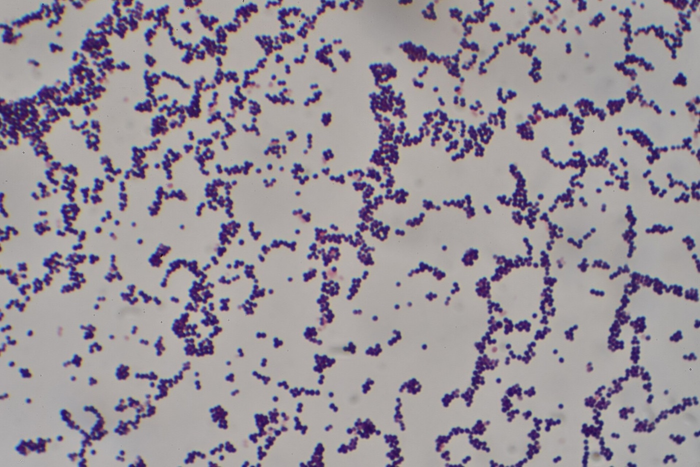 Figure 7. Gram stain of Staphylococcus aureus: gram-positive cocci in grape-like clusters, the predominant cause of all forms of osteomyelitis. Source: Dr Graham Beards, via Wikimedia Commons, CC BY-SA 4.0.
