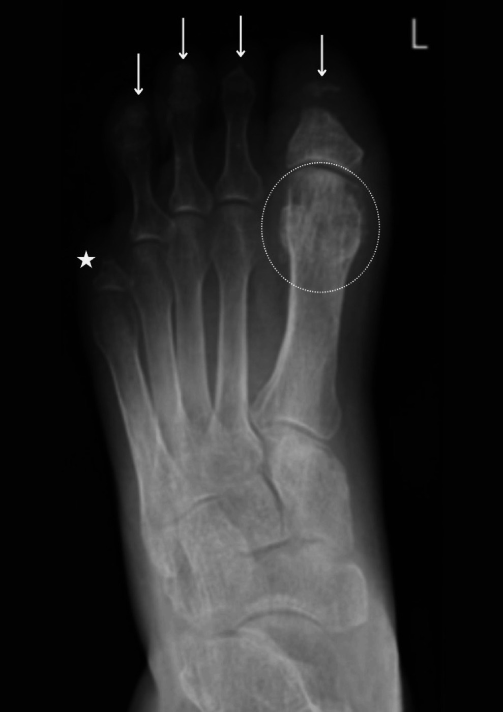 Figure 9. Diabetic-foot osteomyelitis: osteolytic destruction of the phalanges with surrounding soft-tissue swelling. From Ahmed et al. (2025), PMC12108555, CC BY 4.0.