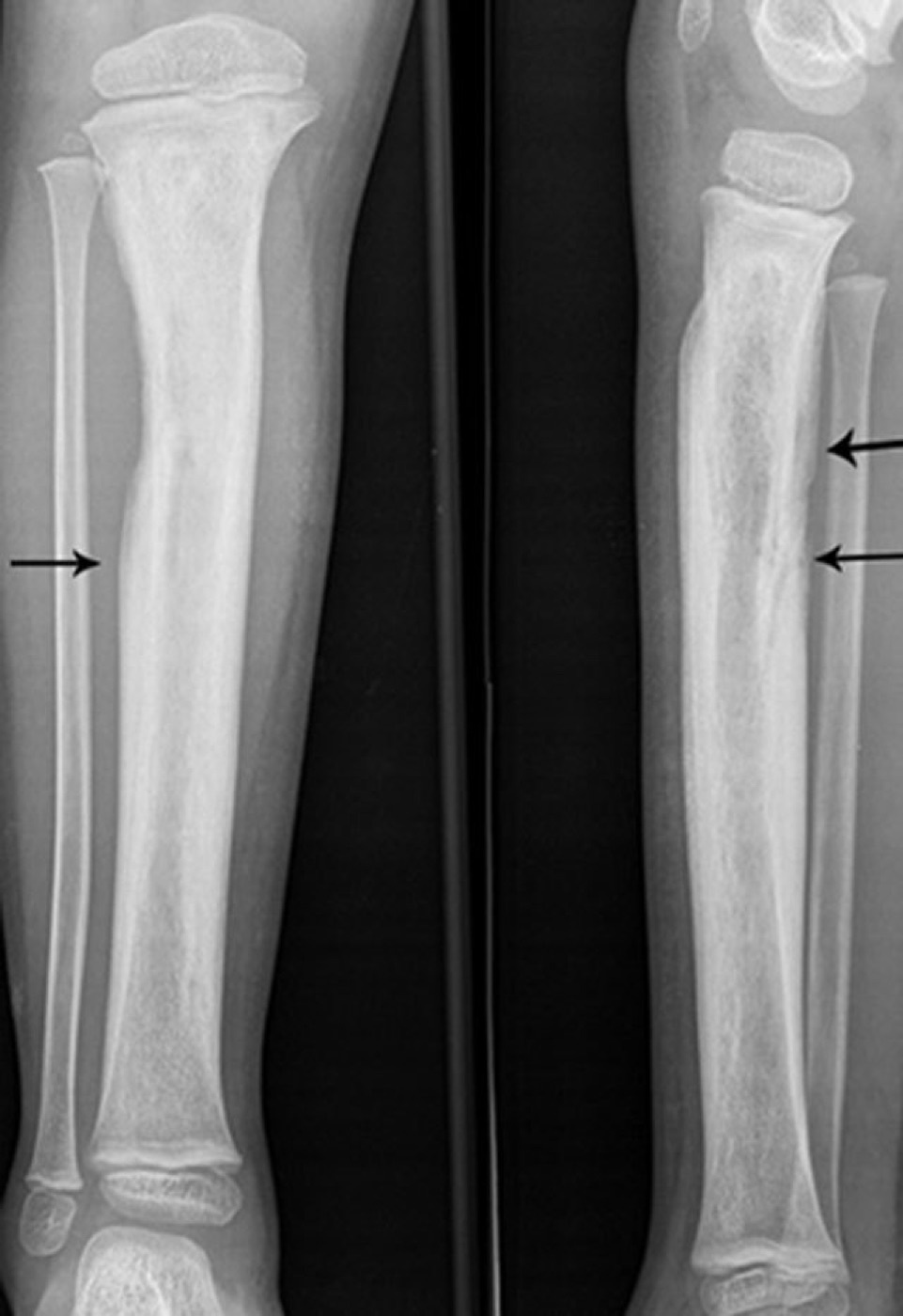 Figure 10. Tibial radiographs showing periosteal new-bone (involucrum) formation in chronic osteomyelitis. From Desimpel, Posadzy & Vanhoenacker (2017), PMC6032807, CC BY 4.0.