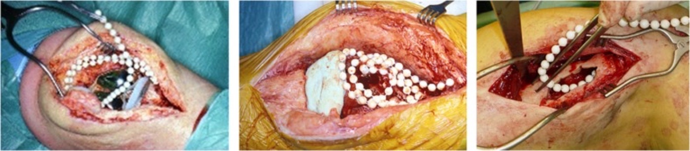 Figure 11. Strings of antibiotic-loaded PMMA beads placed in the surgical field for local antibiotic delivery and dead-space management after debridement. From van Vugt, Arts & Geurts (2019), PMC6671866, CC BY 4.0.