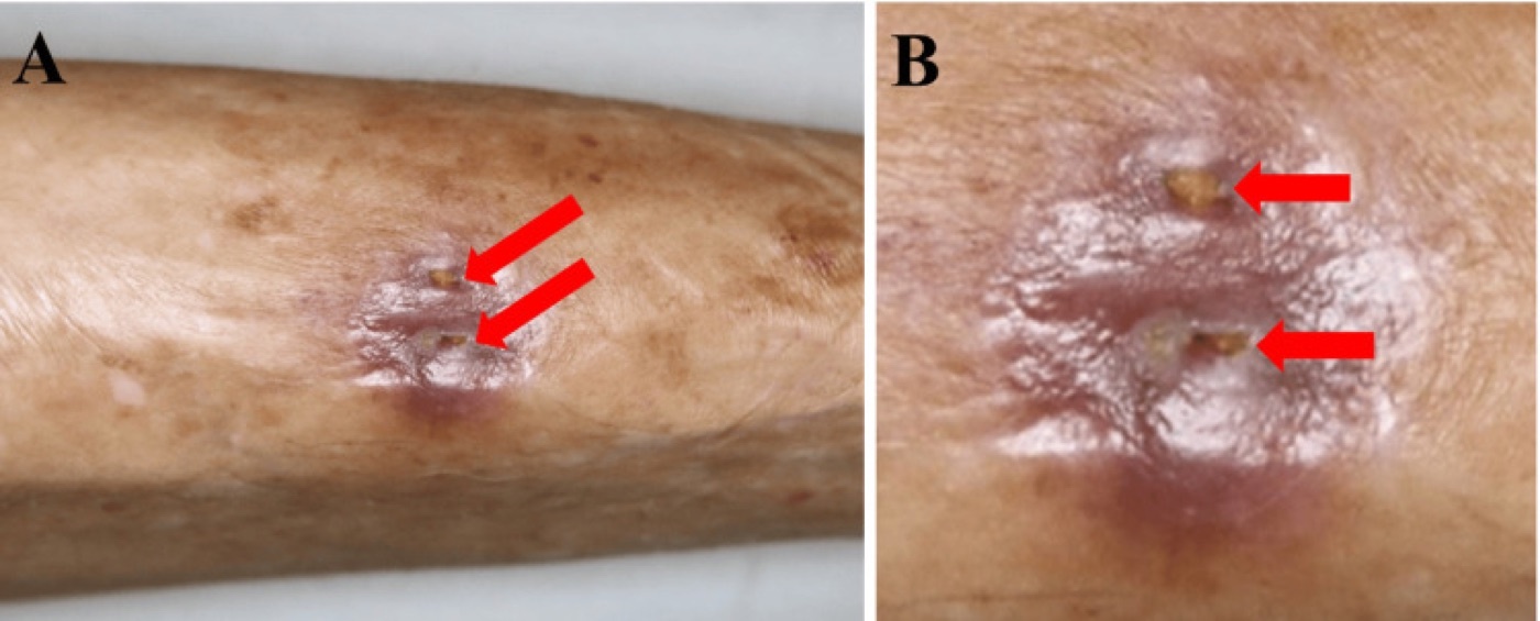 Figure 12. Chronic tibial osteomyelitis with two cutaneous draining sinus-tract openings: a discharging sinus is a strong clinical marker of chronicity. From Ishihara et al. (2025), PMC12459229, CC BY 4.0.