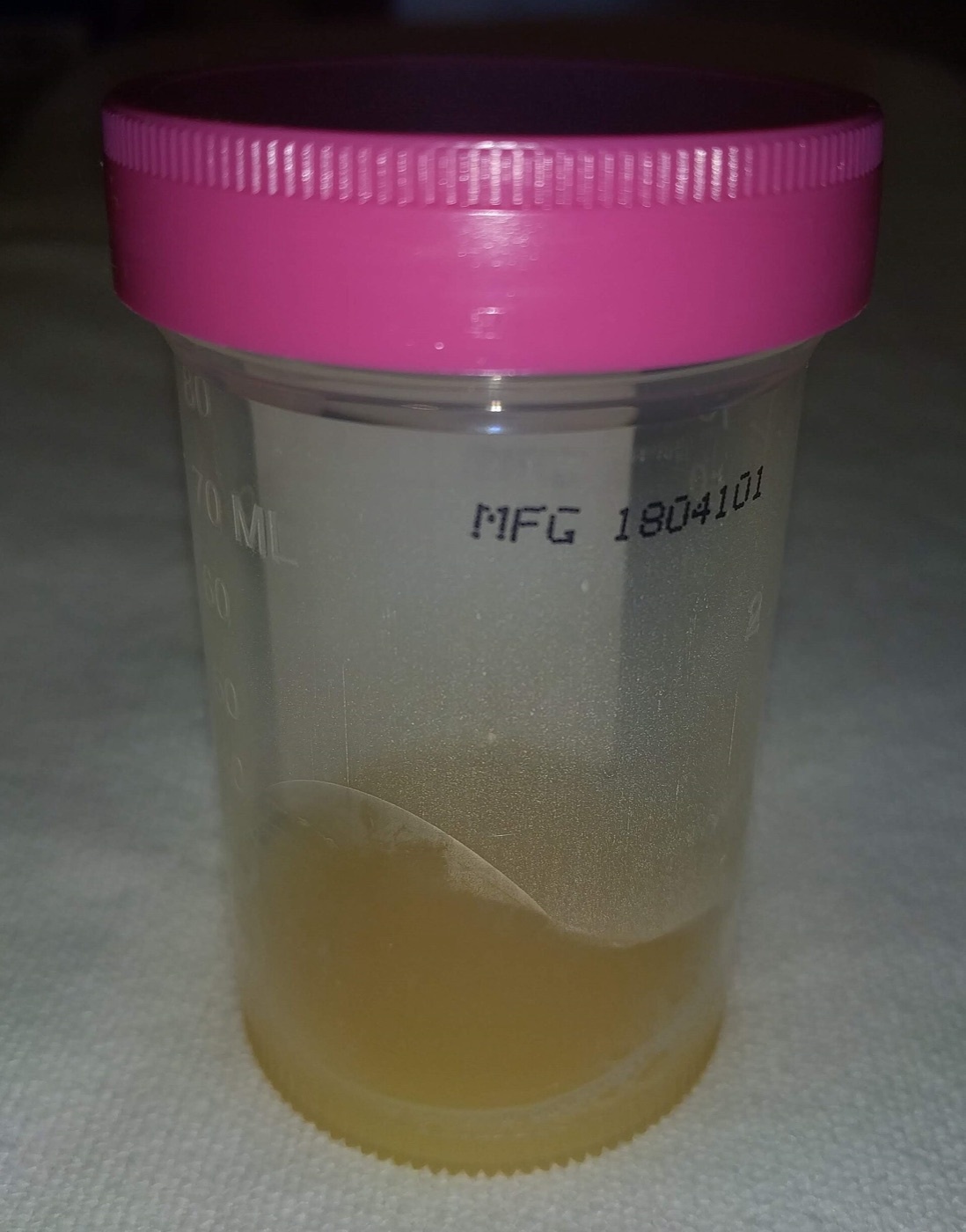 Figure 13. Turbid, purulent synovial fluid aspirated from a septic knee: an effusion this cloudy is infected until proven otherwise. Source: James Heilman, MD, via Wikimedia Commons, CC BY-SA 4.0.