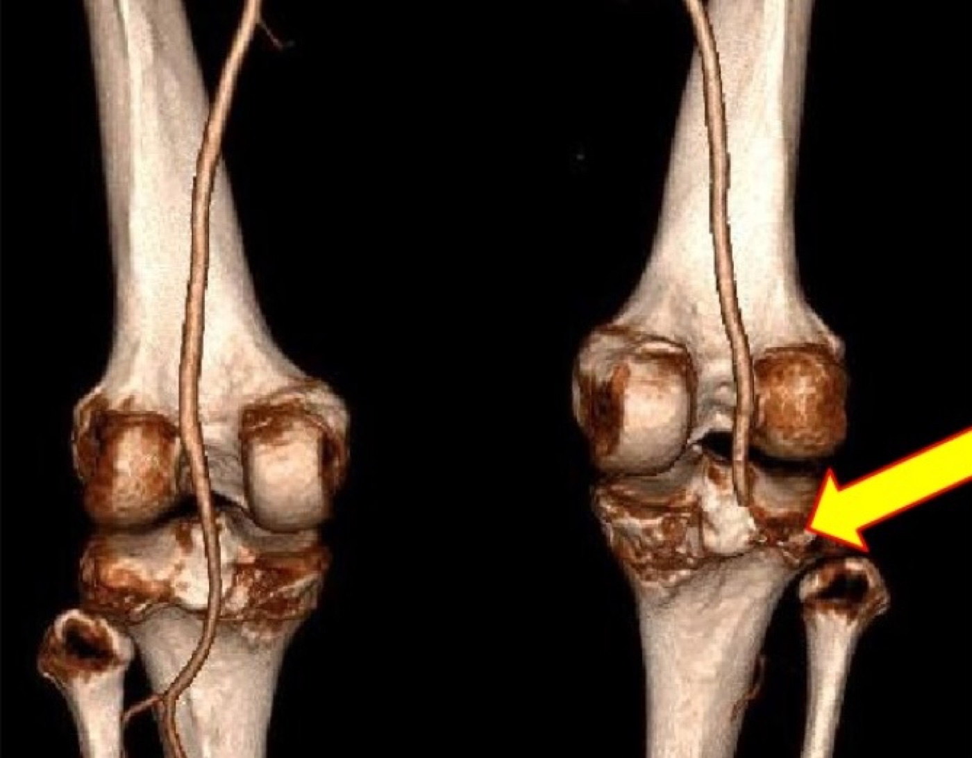 Figure 2. 3D CT angiogram (posterior view) showing occlusion of the right popliteal artery (arrow) with normal vasculature on the left, the vascular complication that makes a knee dislocation a surgical emergency. Image by Godfrey et al., CC BY 4.0, via Wikimedia Commons.