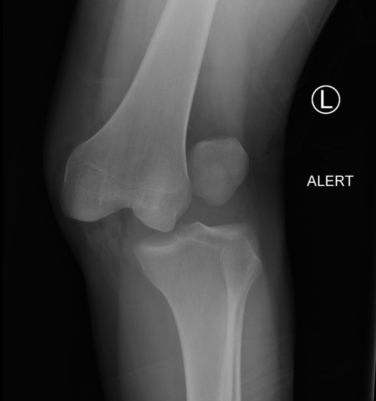 Figure 4. Radiograph of a lateral knee dislocation. Image by Andrew Murphy, CC BY-SA 4.0, via Wikimedia Commons.