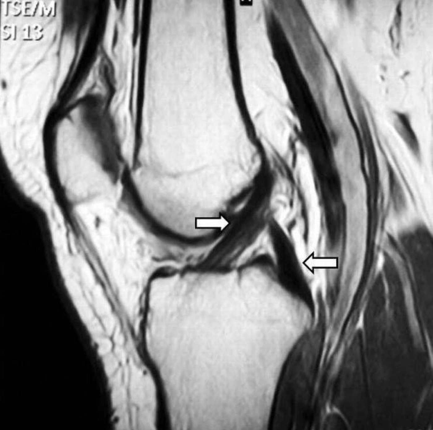 Figure 8. Sagittal knee MRI showing the normal anterior and posterior cruciate ligaments (arrows), the reference appearance against which tears are read. Image by Lykissas et al., CC BY-SA 2.0, via Wikimedia Commons.