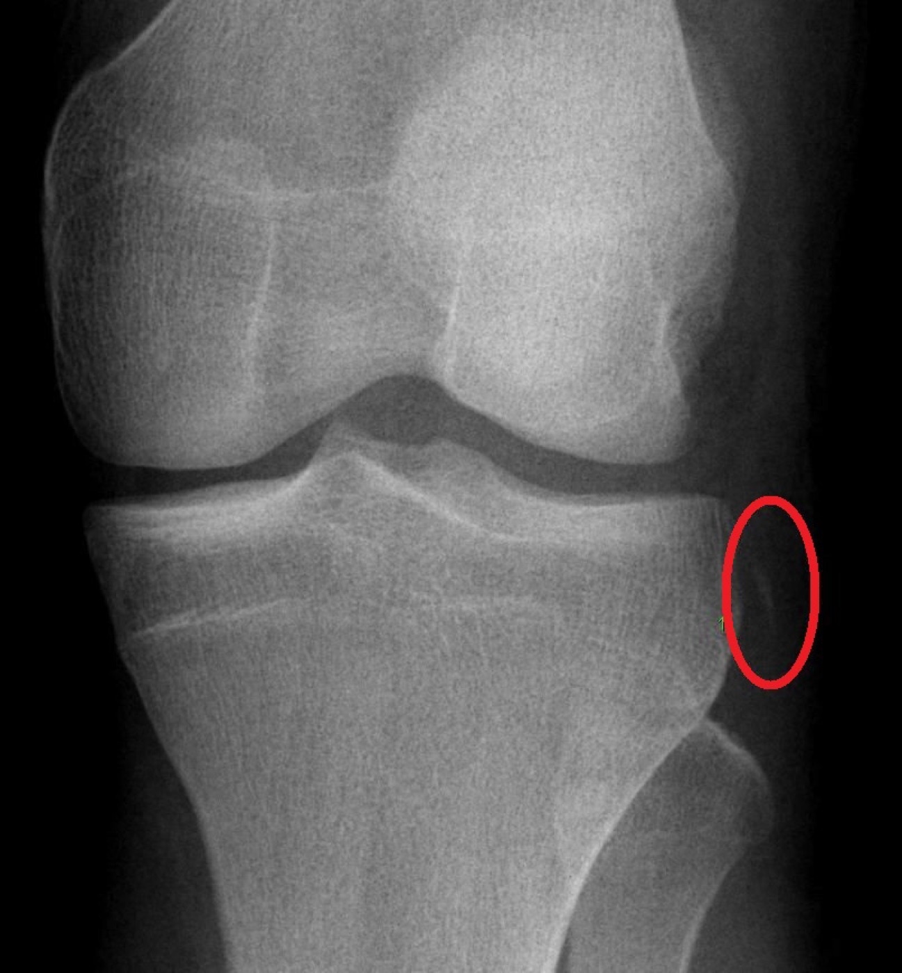 Figure 9. AP knee radiograph showing a Segond fracture, a small avulsion off the lateral tibial plateau (circled), highly associated with an ACL tear. Public domain, via Wikimedia Commons.