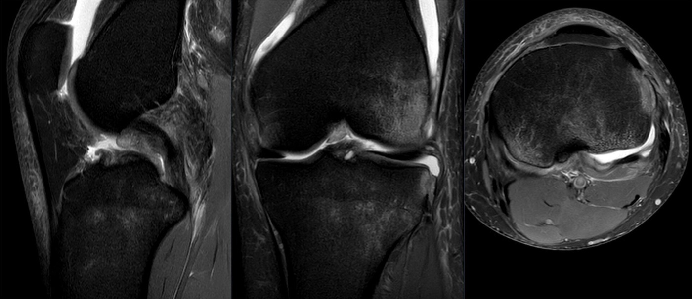 Figure 10. Fat-suppressed knee MRI (sagittal, coronal, axial) of a Segond avulsion with an associated anterior cruciate ligament tear. Image by Hellerhoff, CC BY-SA 4.0, via Wikimedia Commons.