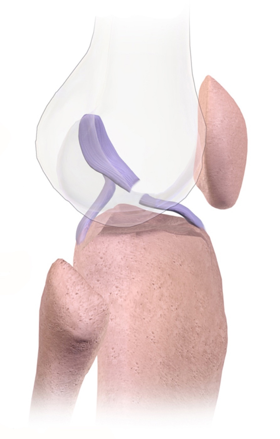 Figure 11. Illustration of an anterior cruciate ligament (ACL) tear. Illustration by BruceBlaus, CC BY-SA 4.0, via Wikimedia Commons.