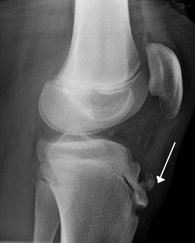 Lateral knee (open physes) in Osgood-Schlatter disease: the white arrow marks fragmentation of the tibial-tubercle apophysis / a separate ossicle at the patellar-tendon insertion. (James Heilman MD, Wikimedia Commons; CC BY-SA 3.0.)