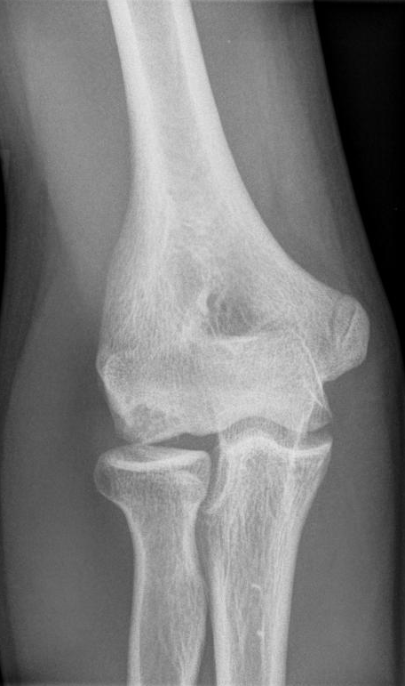 Antero-posterior elbow of a child with Panner disease: the capitellar ossification centre is irregular, fragmented and sclerotic - an osteochondrosis of the capitellum. (Kinderradiologie Olgahospital, Klinikum Stuttgart, Wikimedia Commons; CC BY-SA 3.0.)